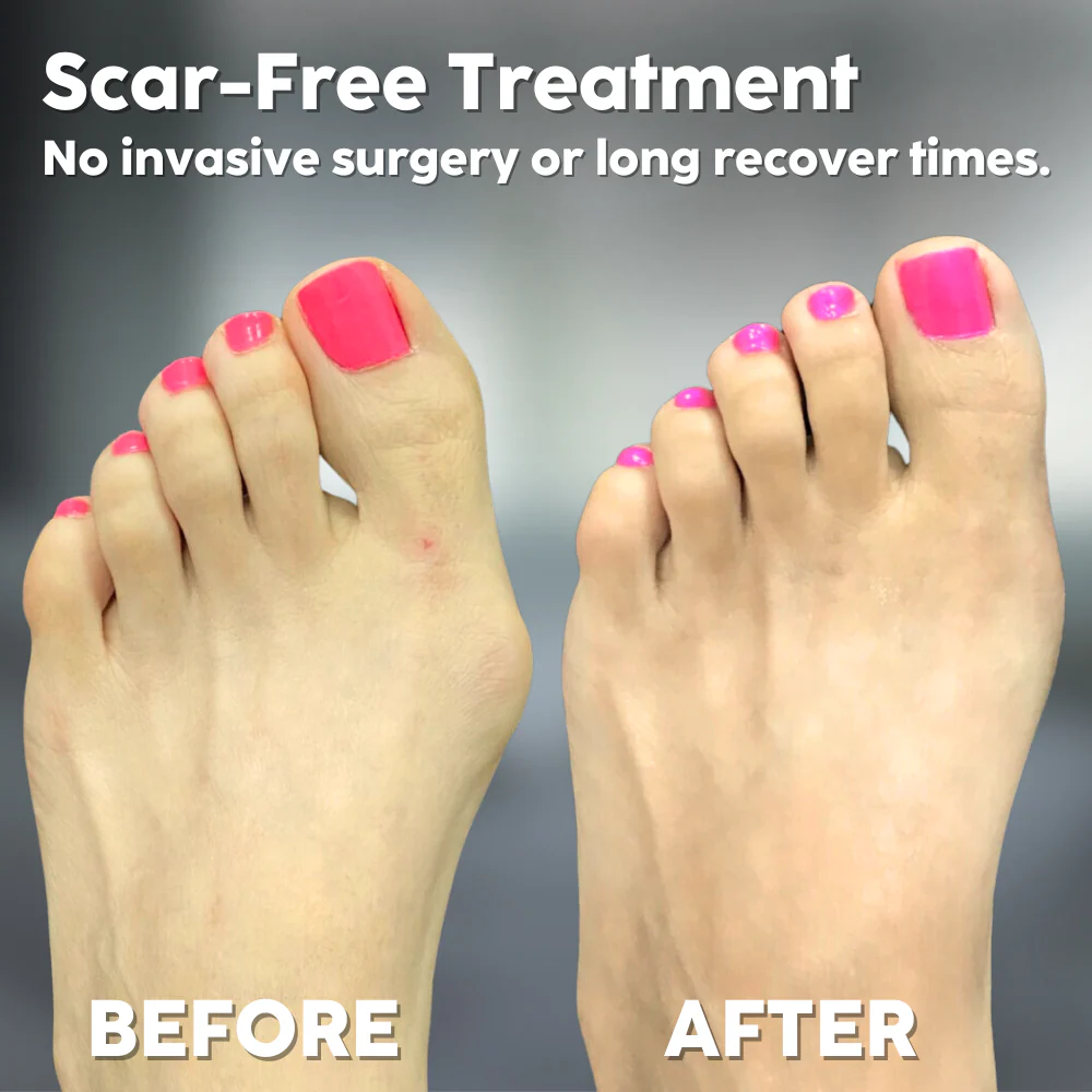 Alignix - Universal Corrector for Hallux Valgus - Image 2