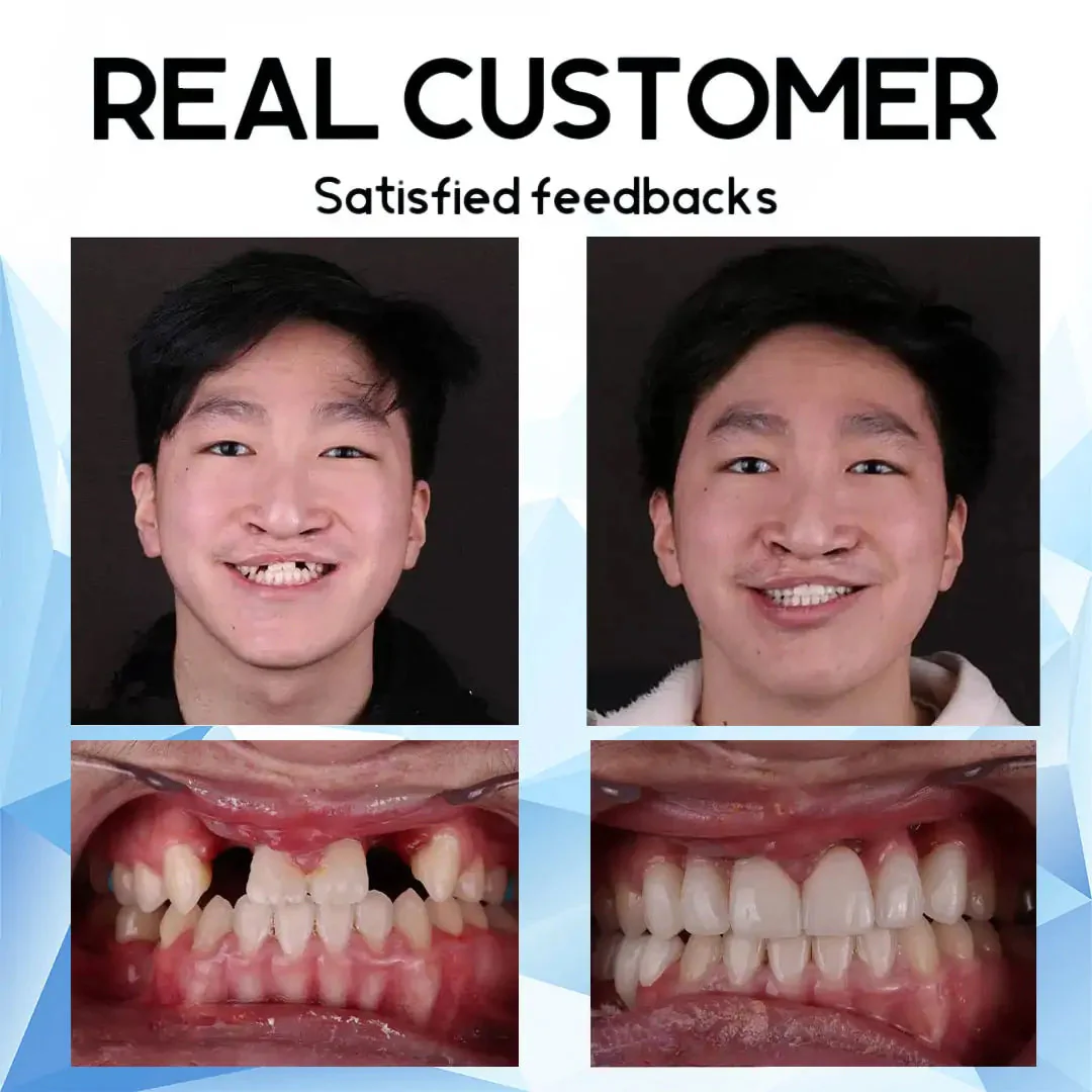 LumaFit™ Denture Refinement — Unlock a Confident Smile That Moves With You All Day Long - Image 11