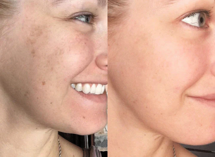 LumiDerma™ — Erase Dark Spots and Unleash Your Radiant Glow - Image 3