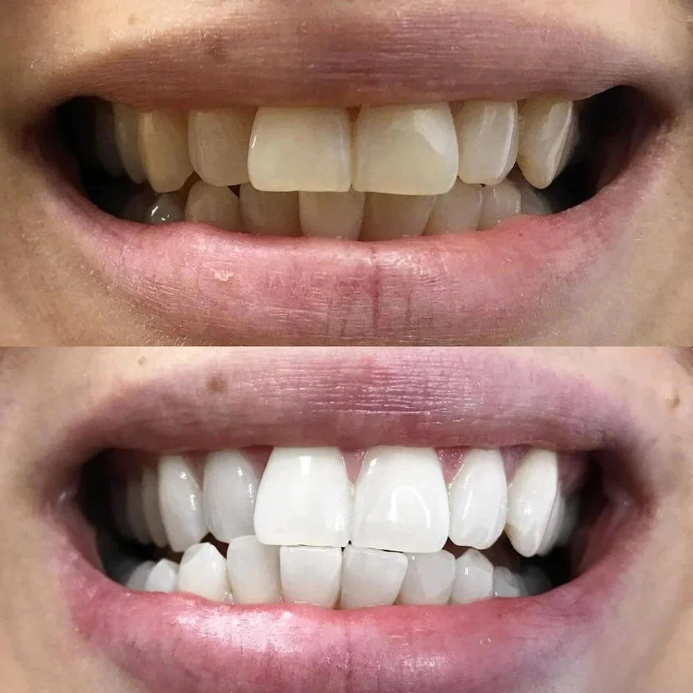 LustreBeam™ — Ignite Instant All-Day Confidence with Every Brilliant Smile - Image 6