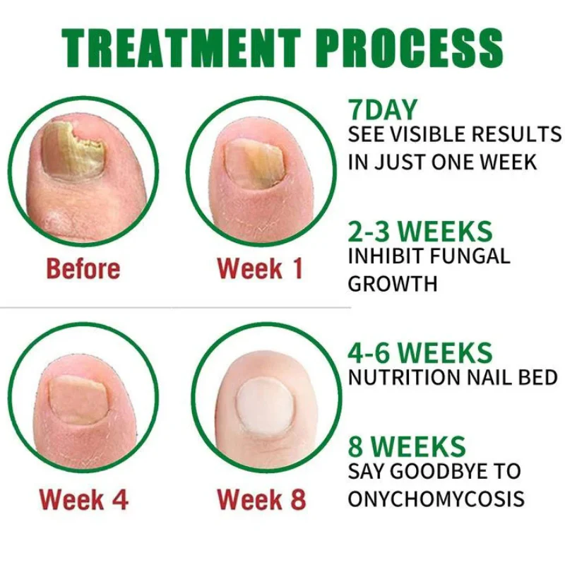 Nail Treatment - Natural Anti-Fungal Treatment - Image 2