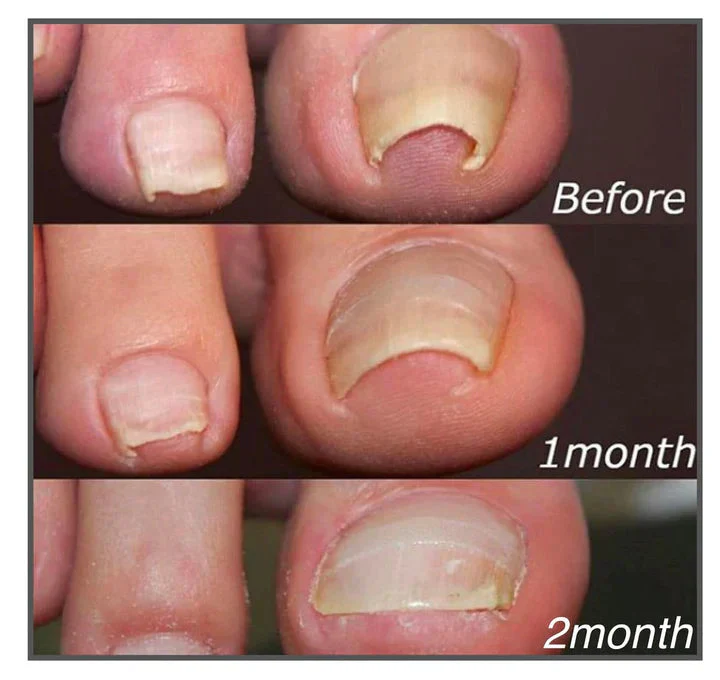 PediAlign™ — End Nail Pain and Reveal Beautiful, Confident Feet Again - Image 2