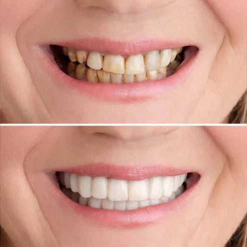 RadianceWrap™ — Transform Your Smile Instantly for Unstoppable Confidence - Image 3