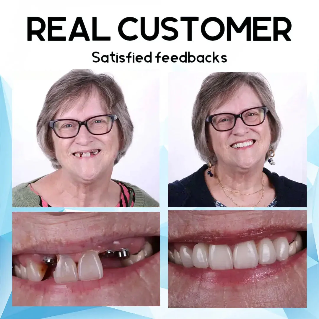 SmilePro™ – High-quality, Individually Fitted Silicone Denture Set - Image 9