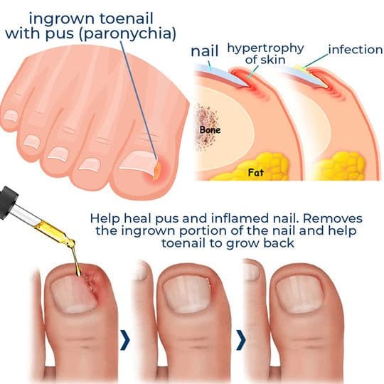 ToenailPlus™ Anti-Paronychia Relief Oil - Image 6